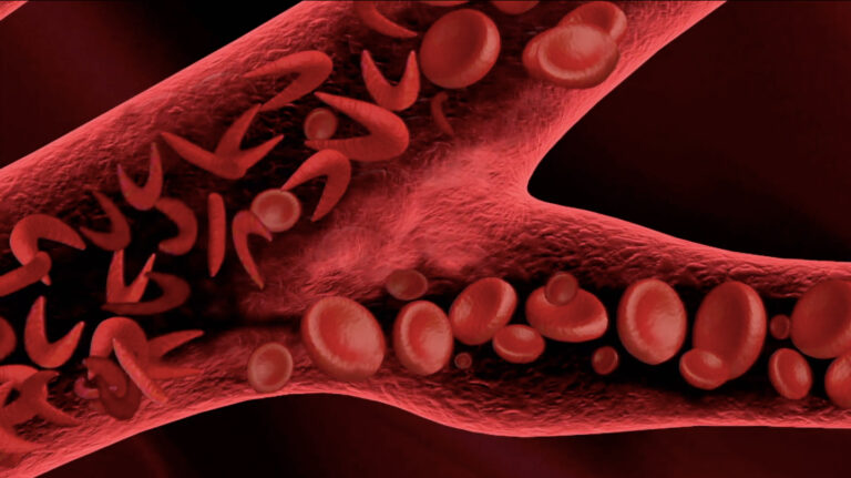 La drépanocytose : une maladie du sang